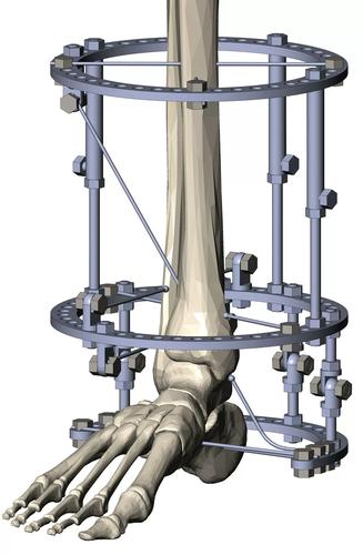 High-precision bone and joint components for medical devices