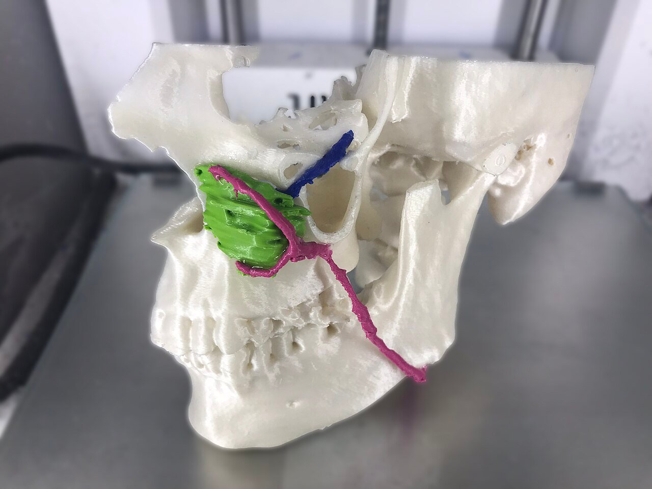 3D-printed anatomical planning model